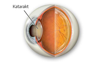 Cataract Eye